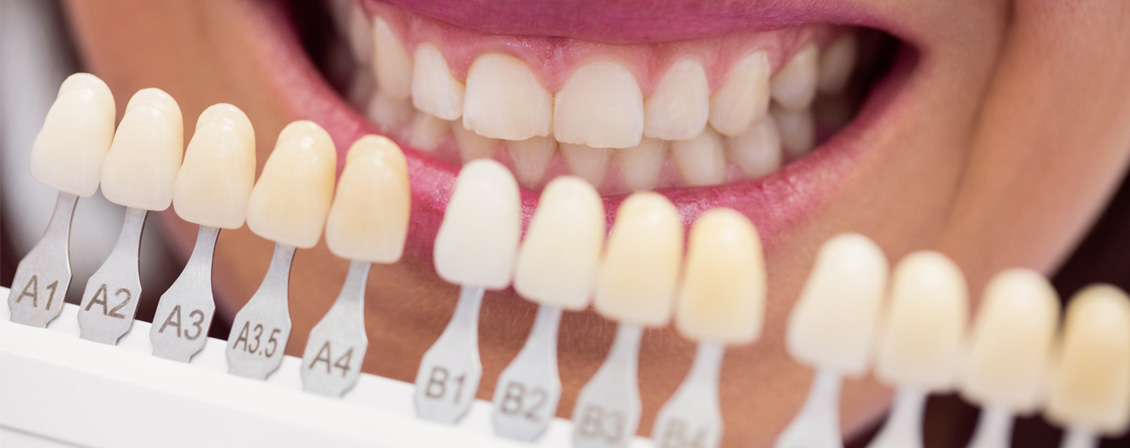Porcelain Veneers