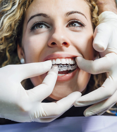 Clear Aligners