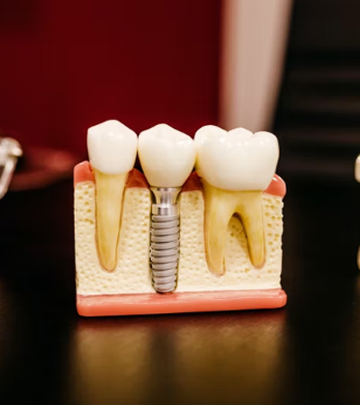 dental brige