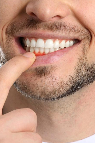 gum disease treatment