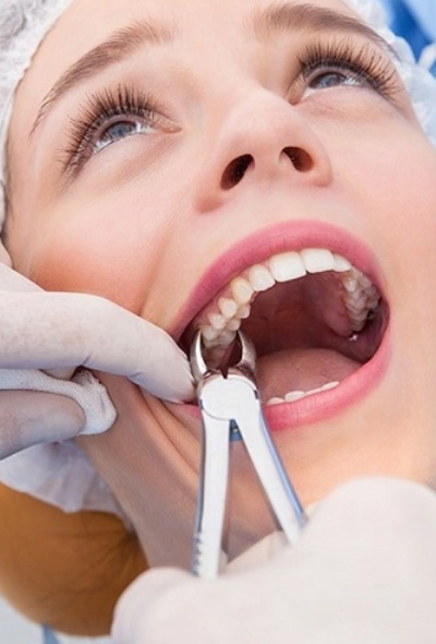 Wisdom Teeth Removal Procedure