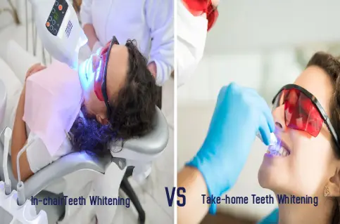 In-chair vs Take-home Teeth Whitening